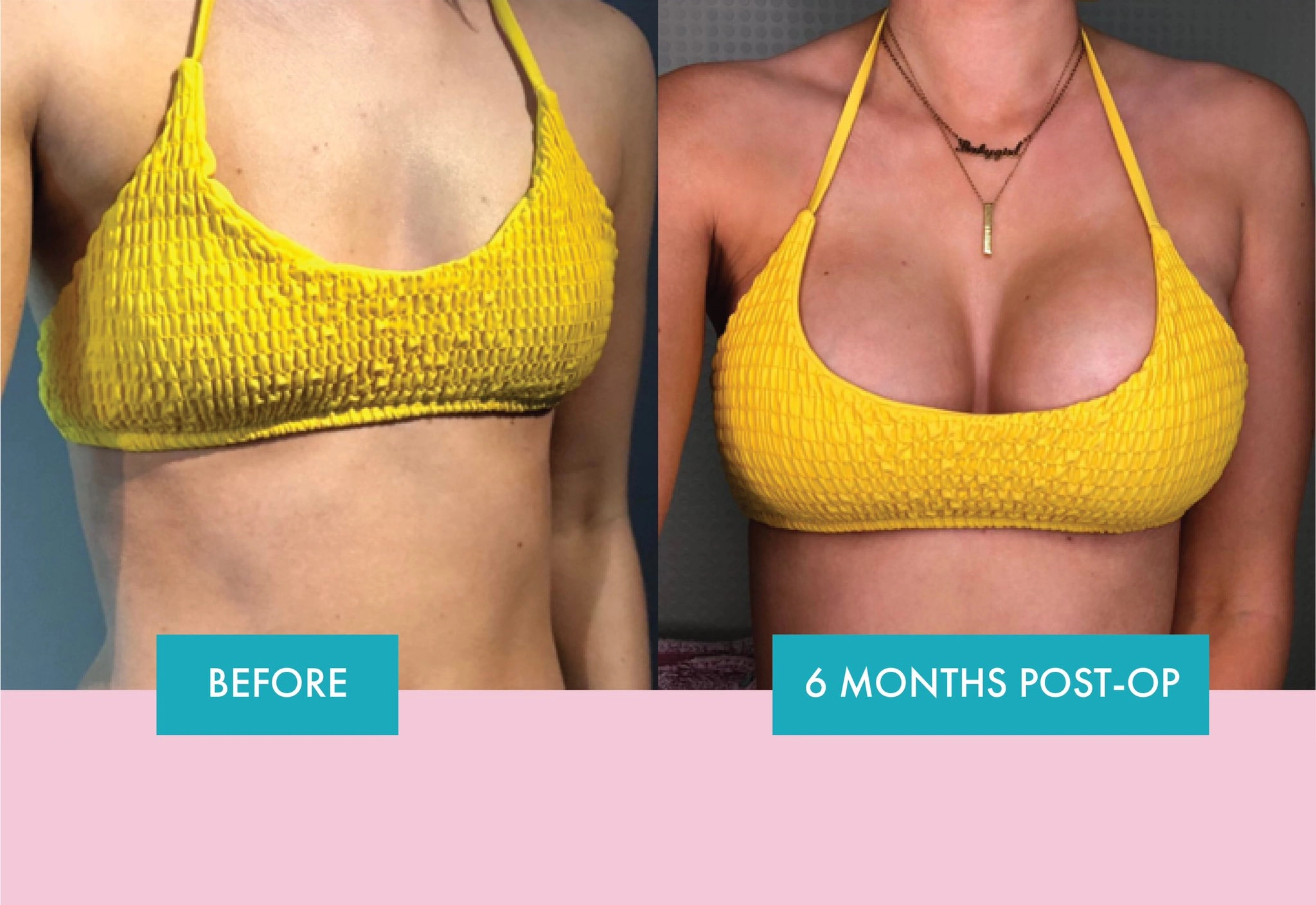 Before and After Breast Implants