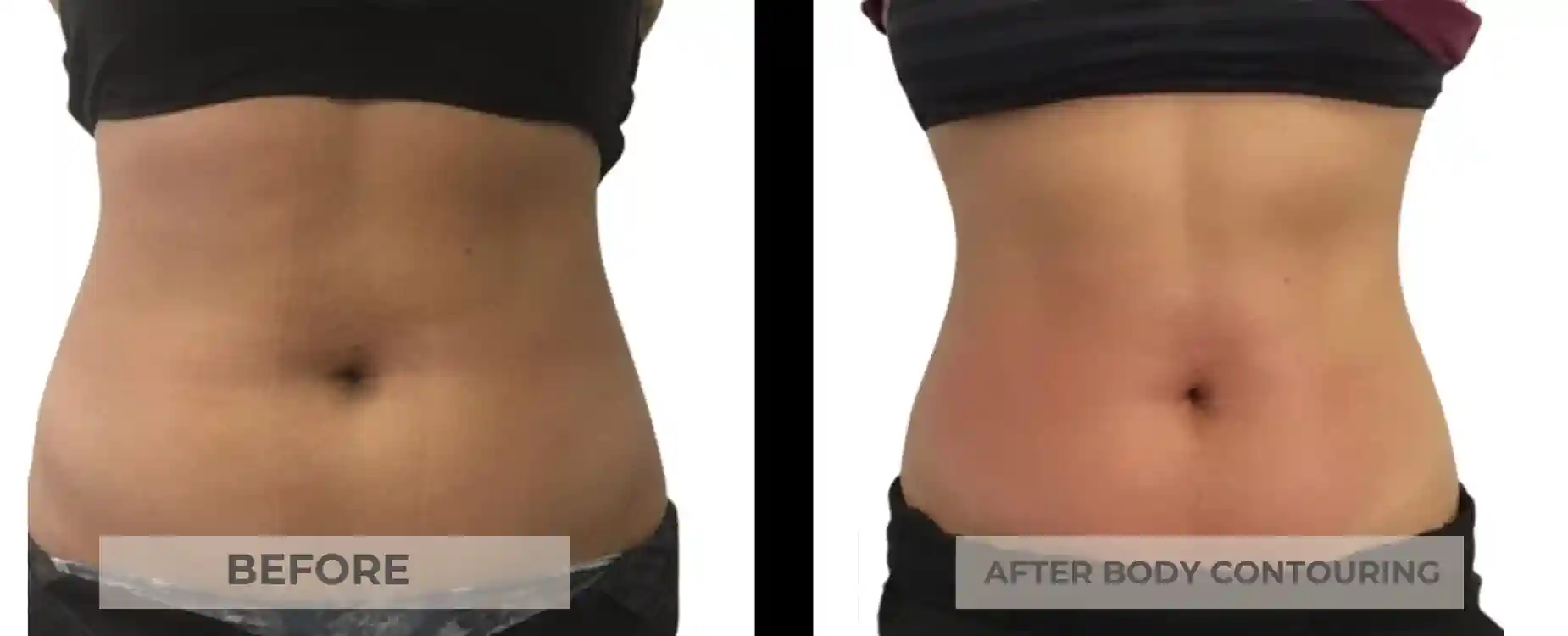 Body Contouring Procedures