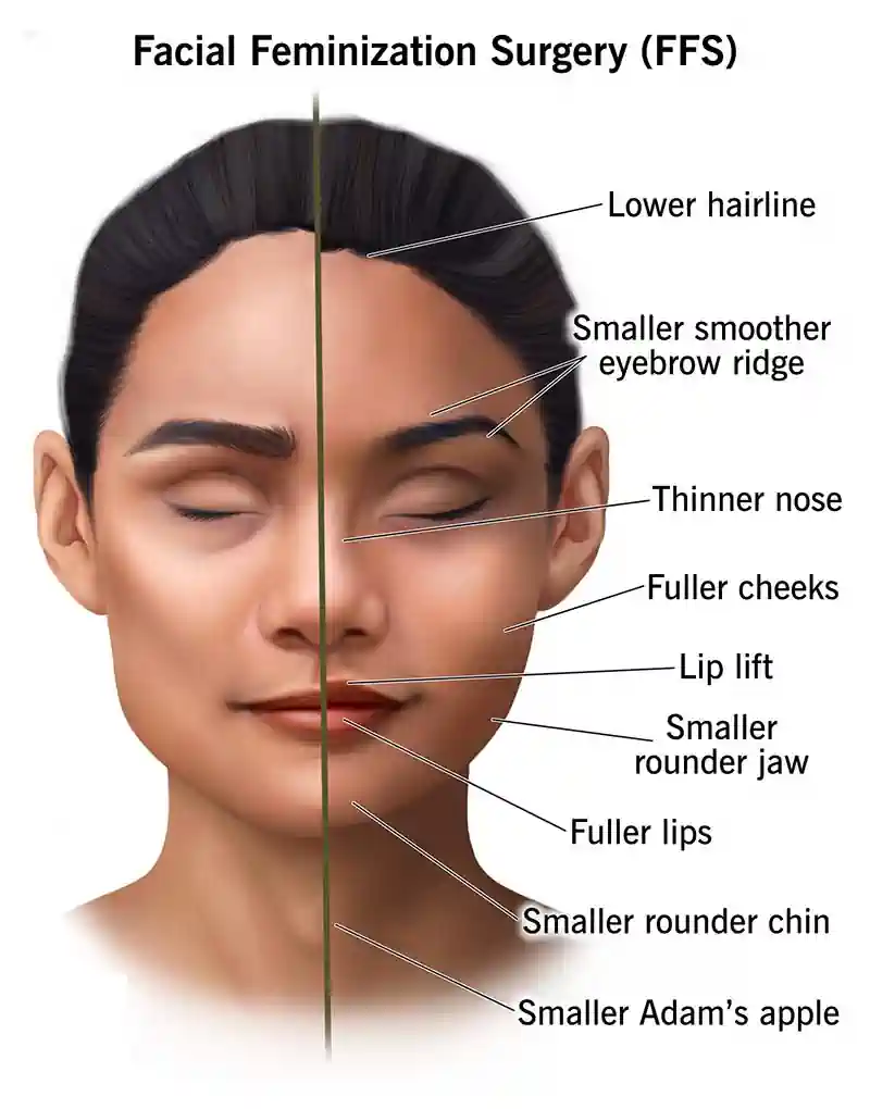 Facial Feminization Surgery