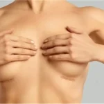 Breast Implant Scars