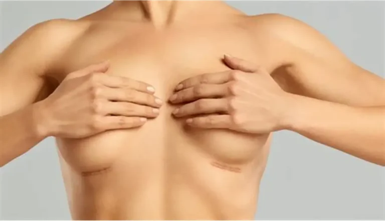 Breast Implant Scars